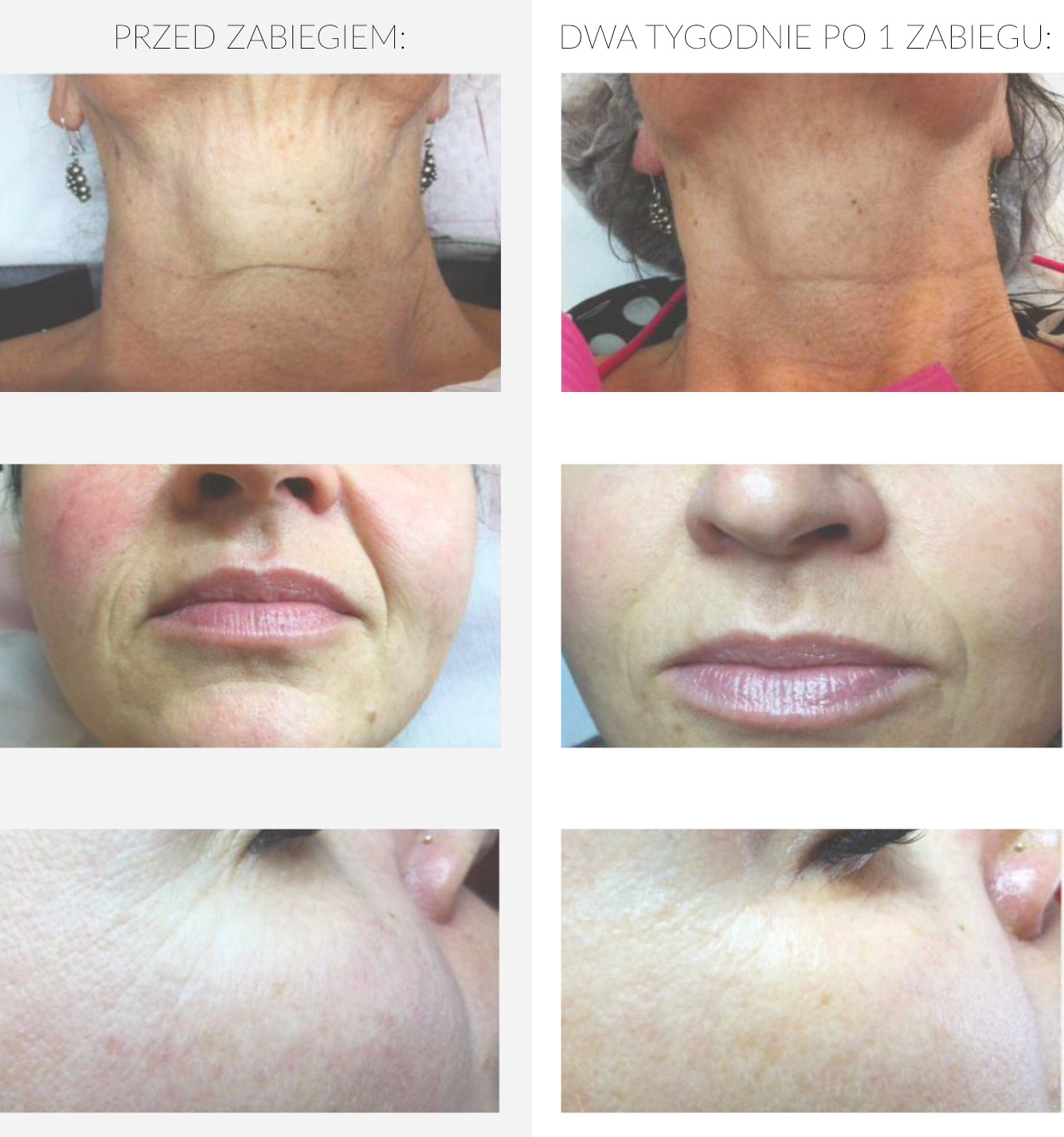 Efekty kwasu hialuronowego